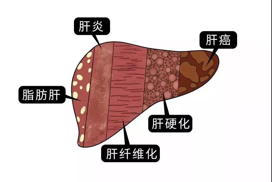 脂肪肝的最大敵人不是肥胖，答案竟是這樣！
